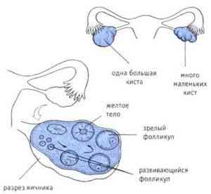 Разрыв кисты яичника: симптомы и основные причины